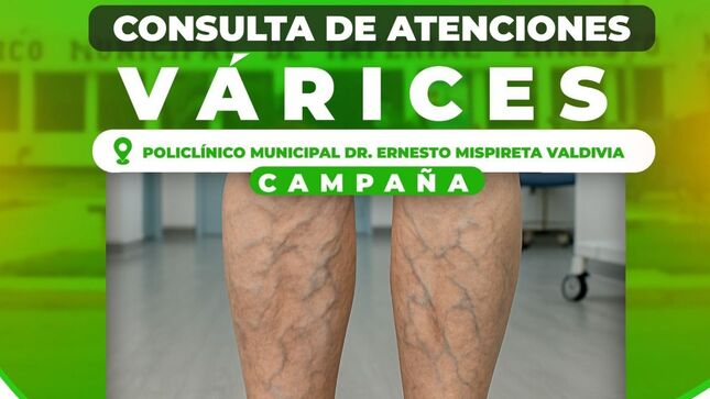Mañana se realizará campaña de Várices en el Policlínioco Ernesto Mispireta