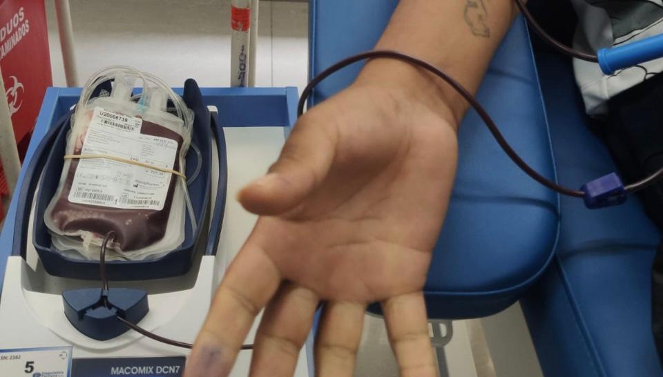 Hospital Loayza invita a la ciudadanía a donar sangre en beneficio de pacientes con quemaduras
