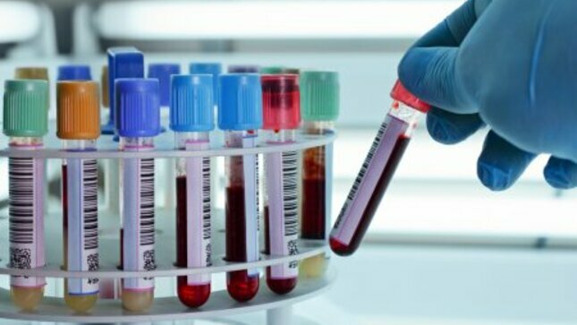 Imagen referencial de tubos hematológicos en el laboratorio
