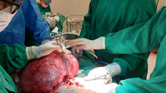 Proeza médica: Retiran tumor de 20 kilos a una mujer de 44 años en el Hospital Emergencia Ate Vitarte
