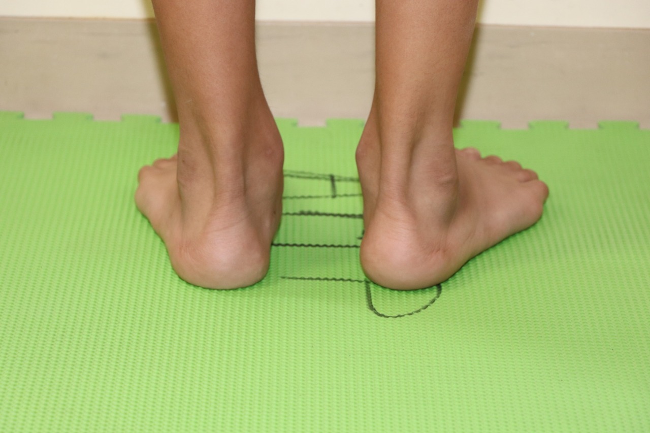 Foto donde se ve los pies planos de un niño.