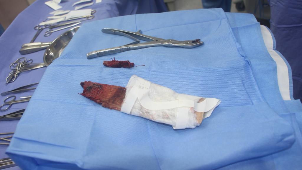 Instituto Nacional de Ciencias Neurológicas salva vida de joven que se le incrustó una tabla de 2 metros en el ojo y cerebro
