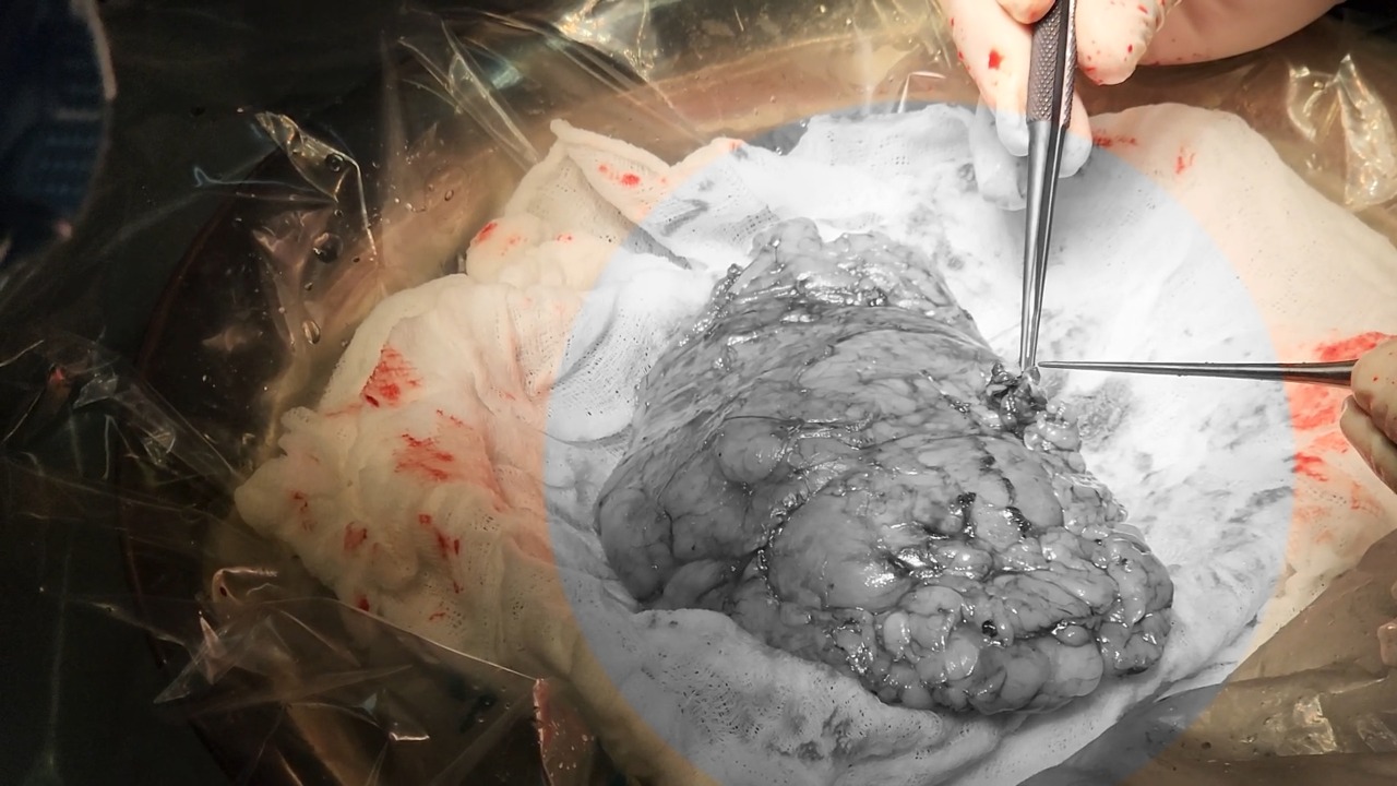Hospital Loayza realiza exitoso trasplante renal de padre a hija-