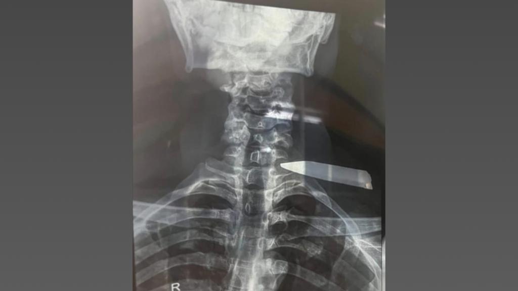 Hospital María Auxiliadora salva la vida de joven agredido con arma blanca en San juan de Miraflores