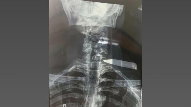 Hospital María Auxiliadora salva la vida de joven agredido con arma blanca en San juan de Miraflores