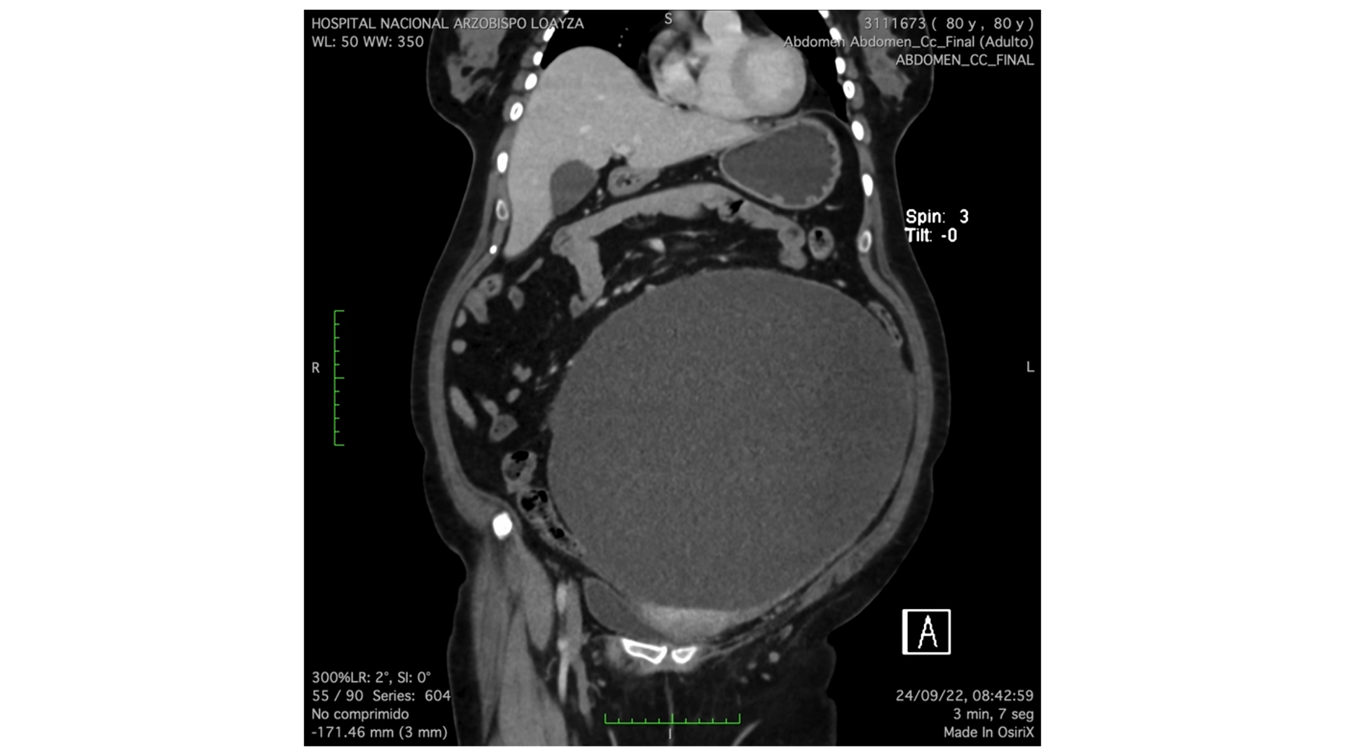 Cirujanos del Hospital Loayza logran remover tumor gigante de mujer proveniente de Tumbes