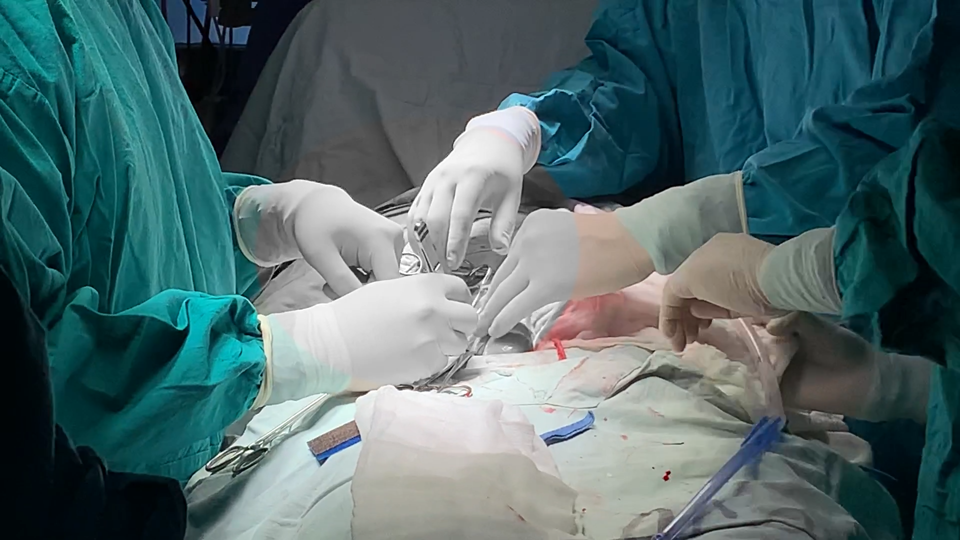 Hospital Loayza realiza exitoso trasplante de riñón de donante no consanguíneo