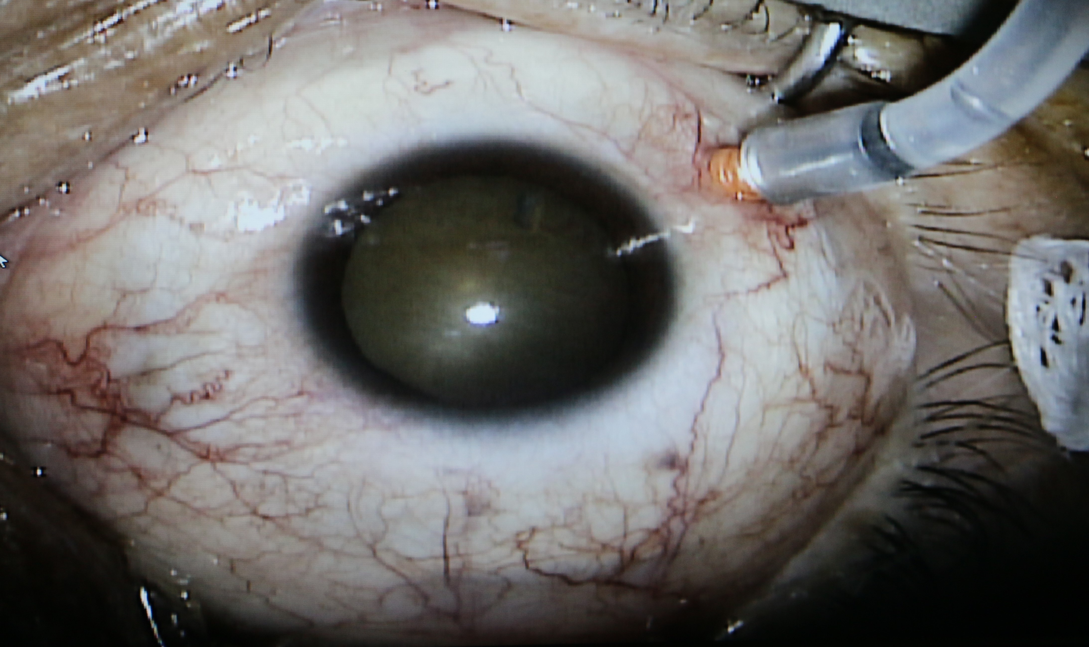 Se ve un catéter con microscopio en el ojo 