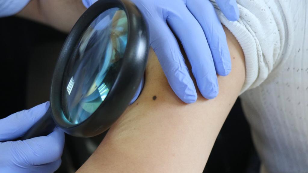 Cáncer de piel: debemos estar atentos a cualquier lesión que aparezca como herida y pasa más de dos semanas sin cicatrizar