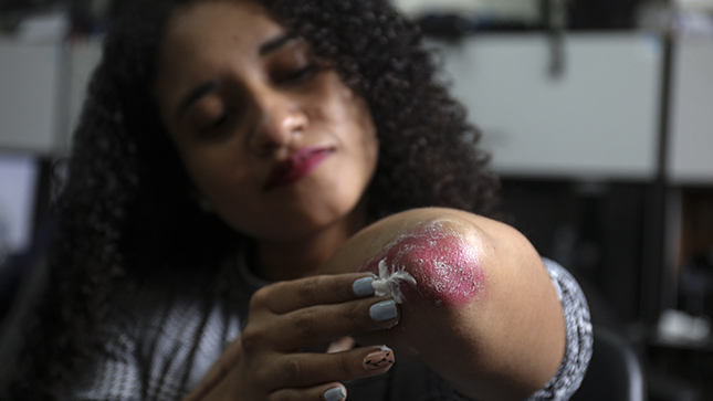 En la foto se ve una joven mostrando su lesión en el codo.