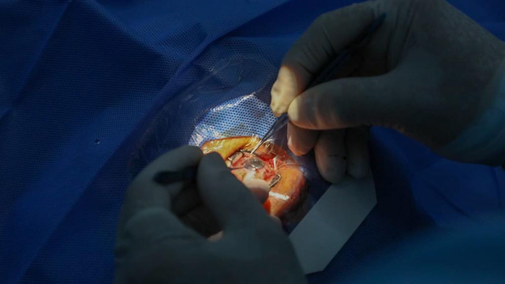 Salud ocular en Loreto realizan primeros trasplantes de córnea en el Hospital de Apoyo de Iquito