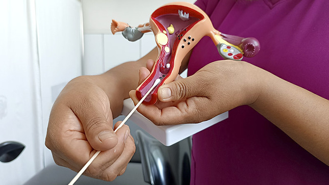 Lima centro: En el 2022 se diagnosticó oportunamente a 500 mujeres con VPH y recibieron el tratamiento gratuito del Minsa