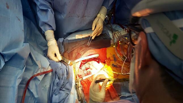 INSN de Breña destaca por realizar cirugías complejas que salvan la vida a pacientes pediátricos 