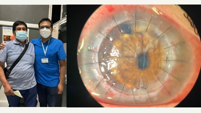 Minsa realiza exitosos trasplantes de corneas a pacientes del Hospital María Auxiliadora 