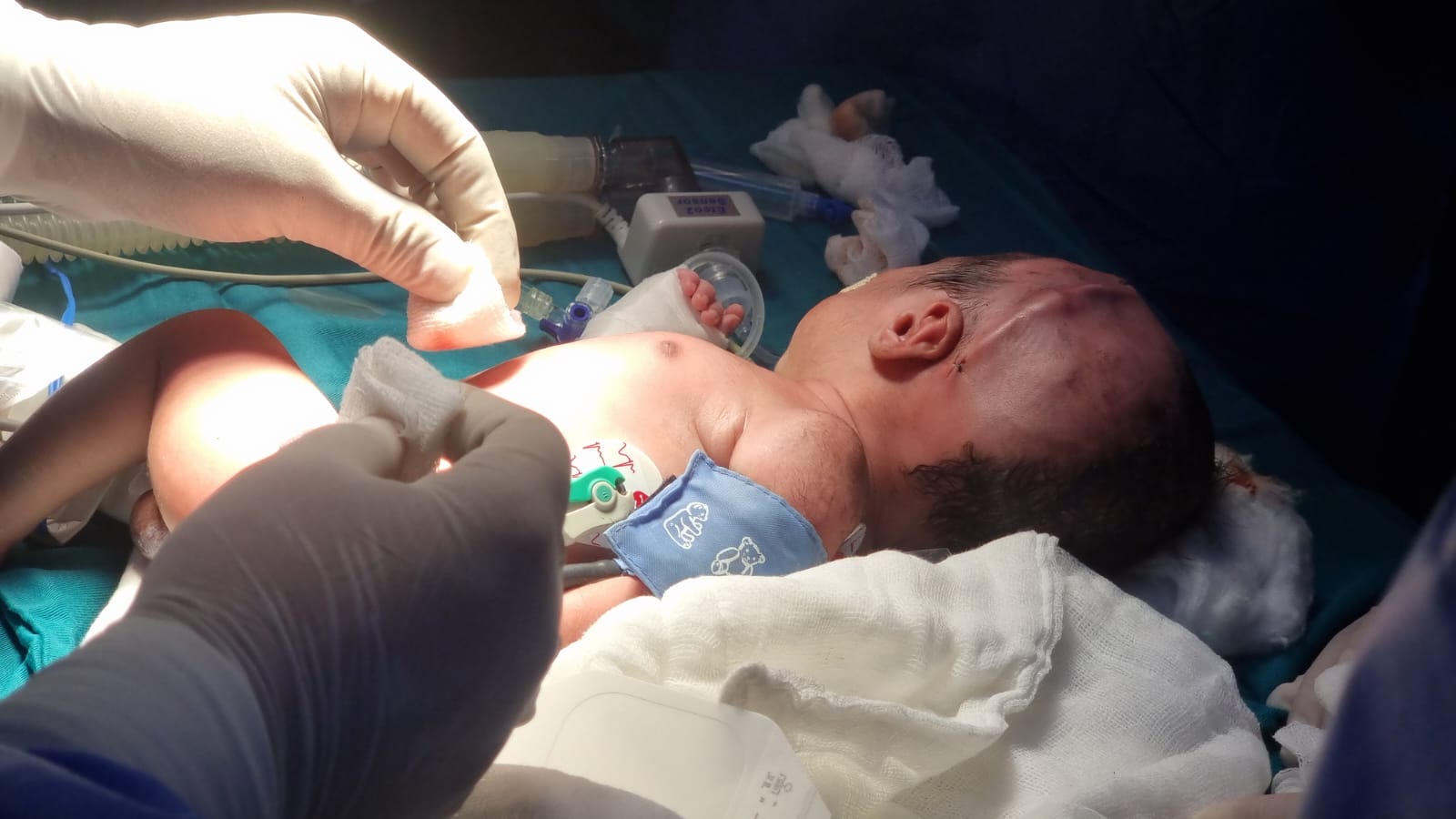 Especialistas del hospital JAMO instalan válvula de drenaje a paciente neonato con hidrocefalia congénita