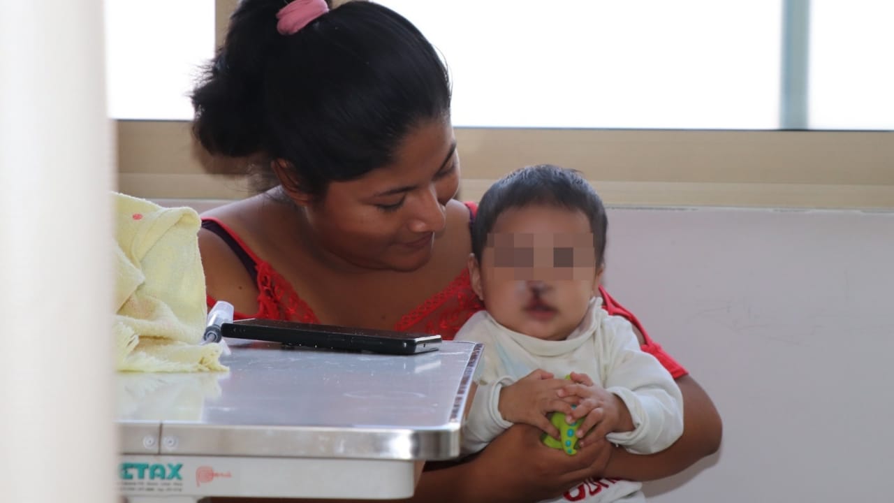 Minsa 26 menores con labio fisurado yo paladar hendido serán operados en el Instituto Nacional de Rehabilitación
