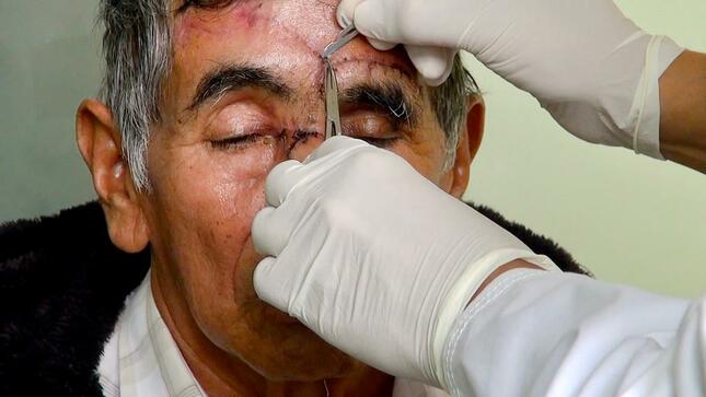 Especialistas del hospital Dos de Mayo reconstruye nariz a paciente de 78 años