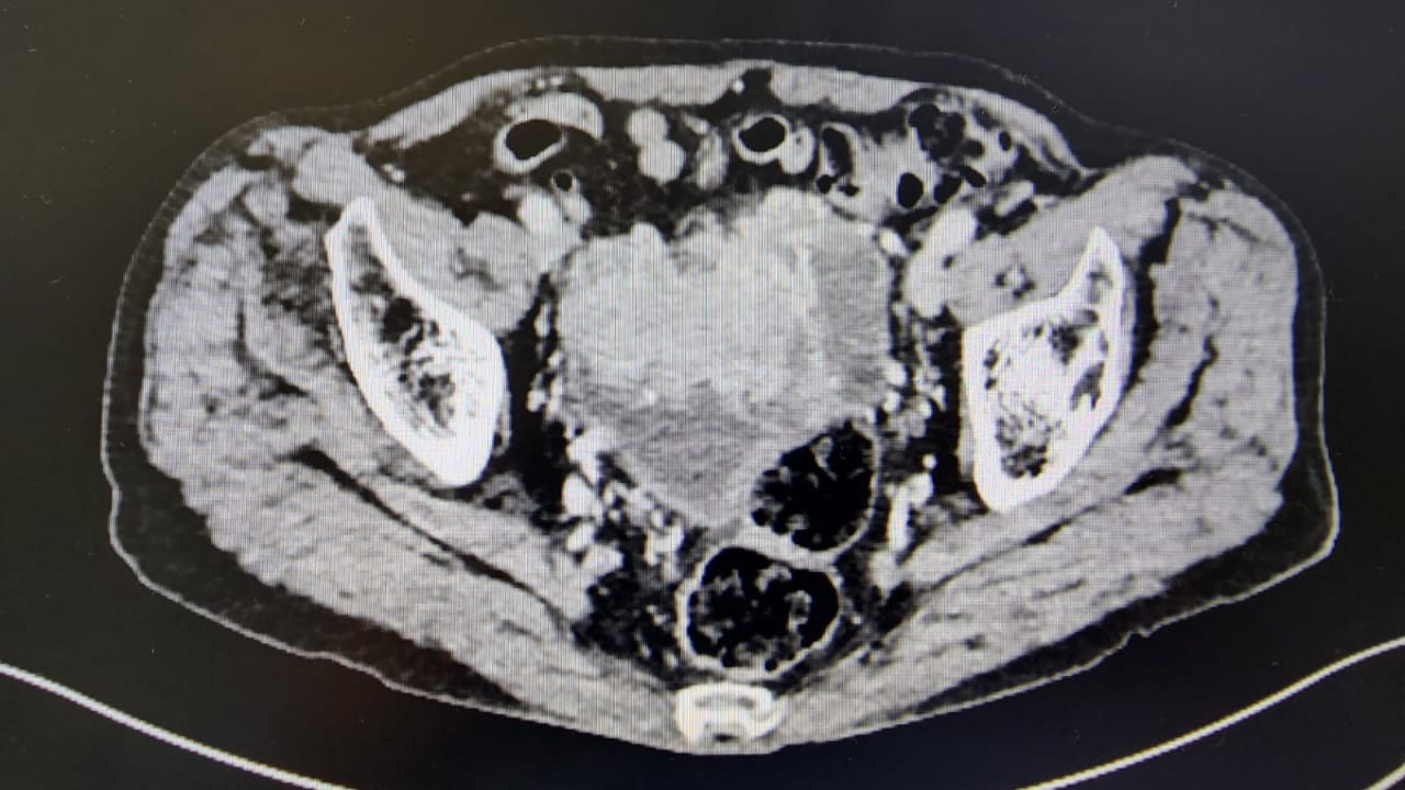 Médicos del IREN Centro reconstruyen vejiga de hombre de 79 años con parte del intestino delgado