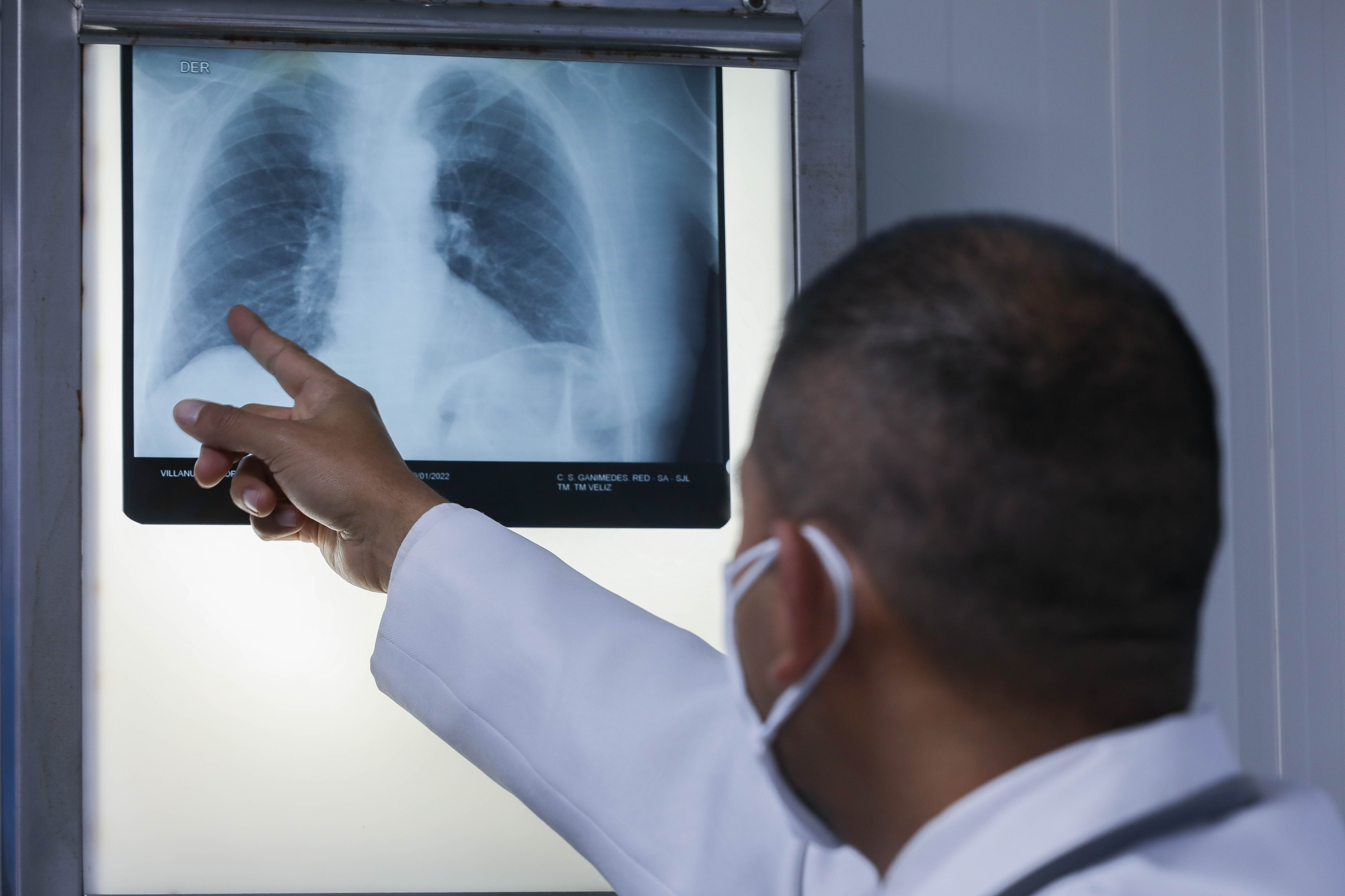 EsSalud alerta incremento de casos de tuberculosis y exhorta a los pacientes a culminar tratamiento