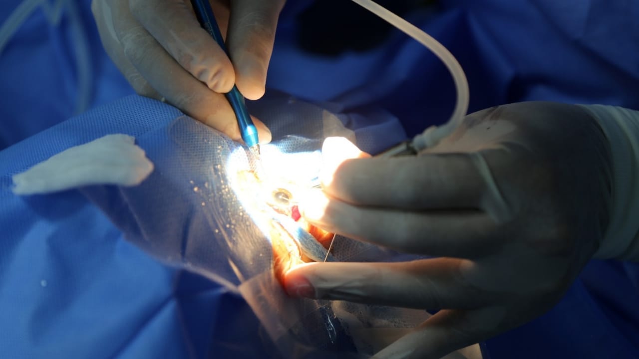 Más de 70 adultos mayores de Cutervo se beneficiarán con cirugías gratuitas de catarata