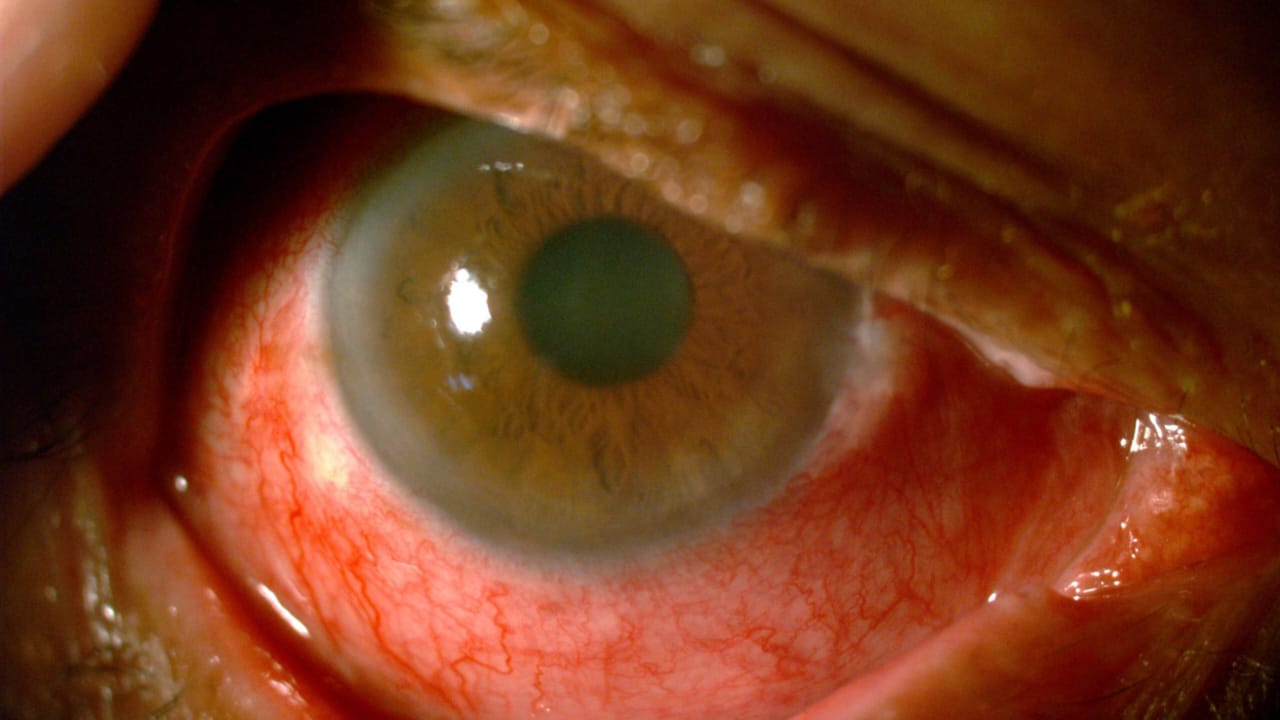 INO: Conozca cómo evitar la conjuntivitis durante el verano