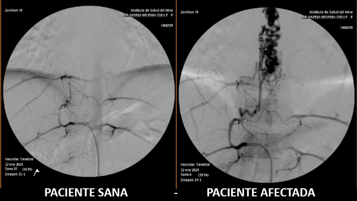 INSN: Exitosa intervención endovascular salvó la vida de una niña de 7 años con una enfermedad rara en la médula