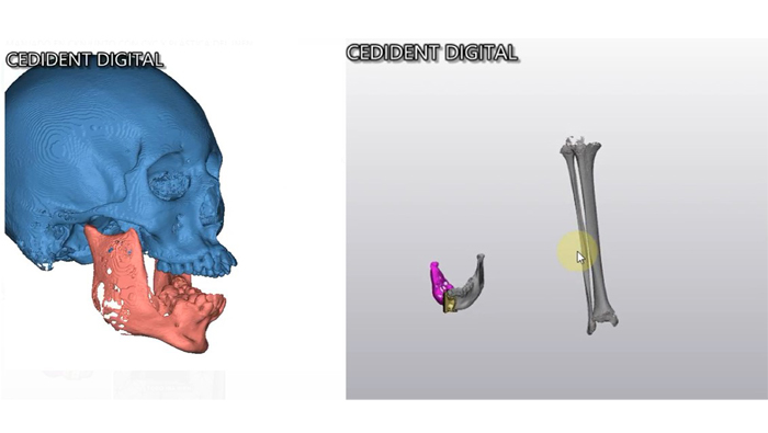 Exitosa reconstrucción de mandíbula devuelve la sonrisa a joven afectado por tumor de rápido crecimiento