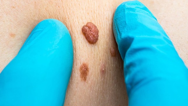 ¡Cuidado con el sol!: Minsa registró más de 3500 casos de cáncer de piel del 2021 al 2023