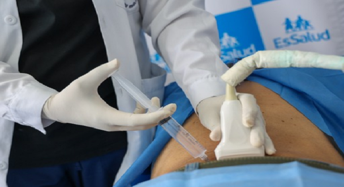 Hospital Rebagliati de EsSalud realiza más de 300 sesiones mensuales de ozonoterapia para controlar dolor en pacientes