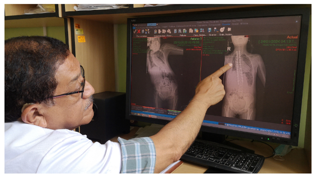 La escoliosis idiopática, en casos extremos, compromete a los pulmones. 