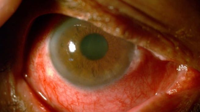 Conjuntivitis: tratamiento adecuado y oportuno permite rápida recuperación de la visión