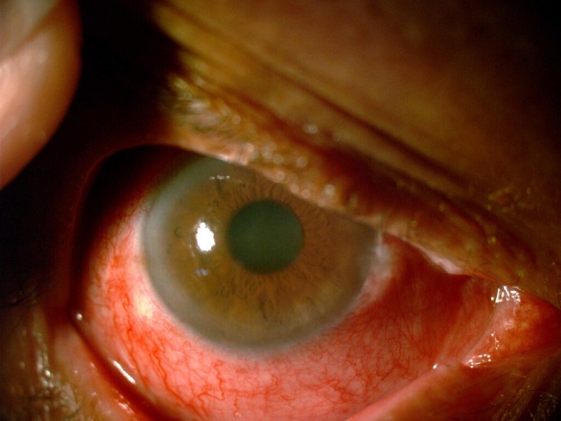 Primer plano de un ojo afectado por conjuntivitis