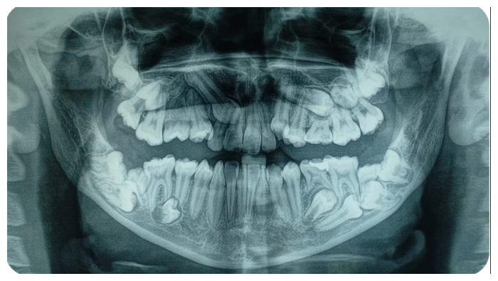 El Dr. Walter Lozano recomendó a los padres a observar a sus hijos especialmente en el cambio de las piezas dentales y ante alguna anomalía traerlos al Servicio Bucal y Maxilofacial del INSN.