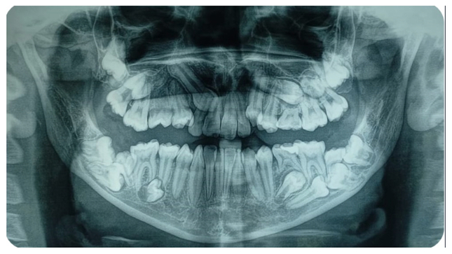 El Dr. Walter Lozano recomendó a los padres a observar a sus hijos especialmente en el cambio de las piezas dentales y ante alguna anomalía traerlos al Servicio Bucal y Maxilofacial del INSN.