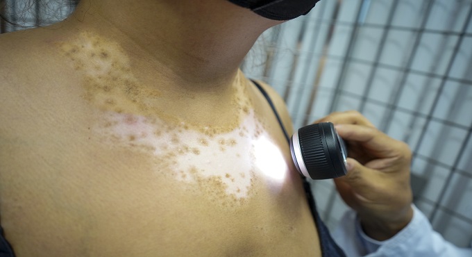 Hospital Almenara de EsSalud brindó tratamiento de fototerapia a más de 500 pacientes con vitíligo