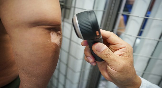 Hospital Almenara de EsSalud brindó tratamiento de fototerapia a más de 500 pacientes con vitíligo