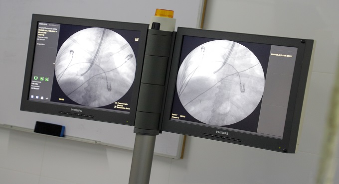EsSalud: Hospital Rebagliati realiza con éxito nuevo procedimiento no invasivo para detectar fibrosis pulmonar