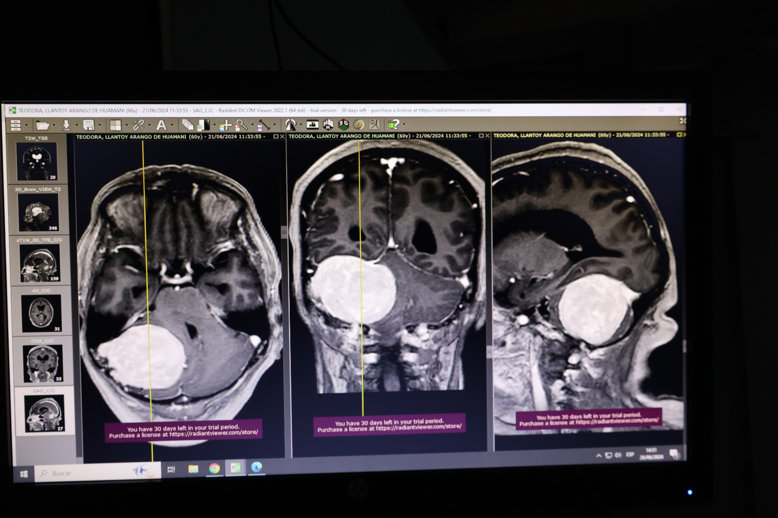 Imagen radiológica de tumor