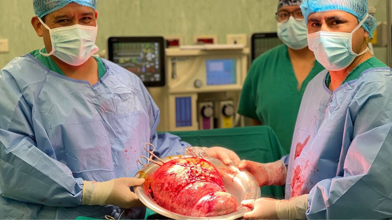 Minsa especialistas del Hospital de Emergencias Villa El Salvador realizaron exitosa cirugía de mioma uterino de 40 centímetros