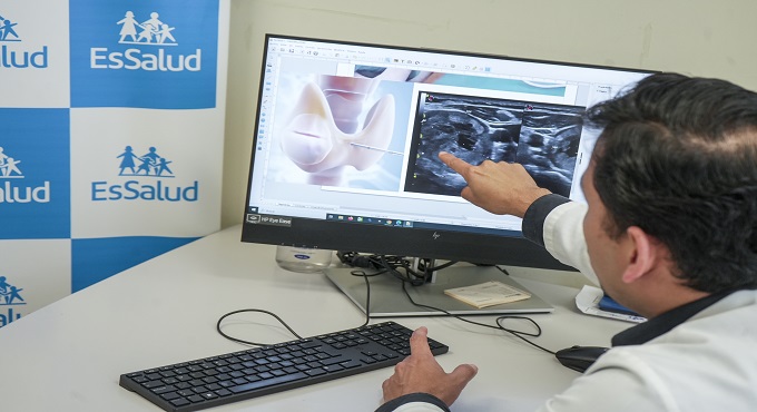 EsSalud: Médicos reducen tumor en el cuello de madre de familia sin necesidad de cirugía
