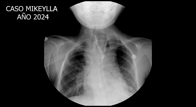 Proeza médica en EsSalud: reconstrucción de esófago permite que niña de 9 años coma por primera vez
