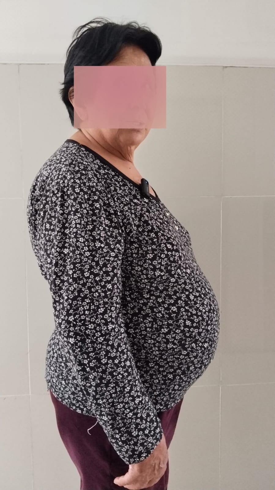 tumor1