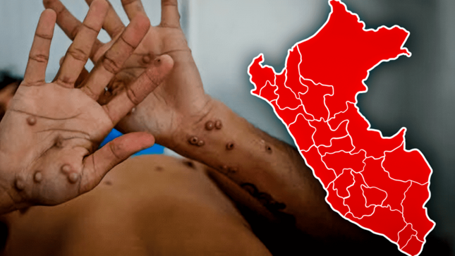 Alerta Epidemiológica del MINSA ante la aparición de un nuevo clado Ib del virus de Mpox en el Perú
