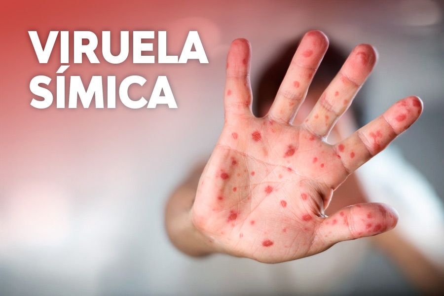 Capacitación virtual sobre “Manejo clínico de la viruela símica”
