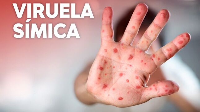 Capacitación virtual sobre “Manejo clínico de la viruela símica”