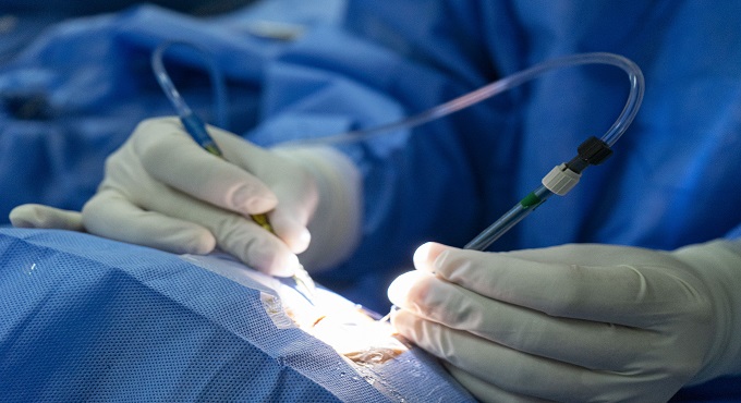 Hospital Sabogal de EsSalud realizó más de 5,000 cirugías oftálmicas en 2024
