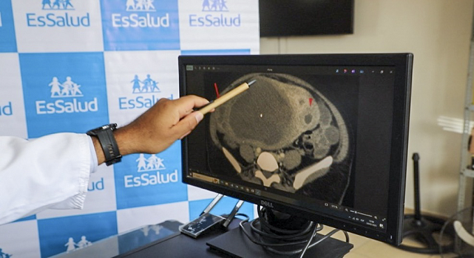 EsSalud: Médicos de Ica extirpan enorme tumor abdominal que simulaba un embarazo en una mujer de 39 años