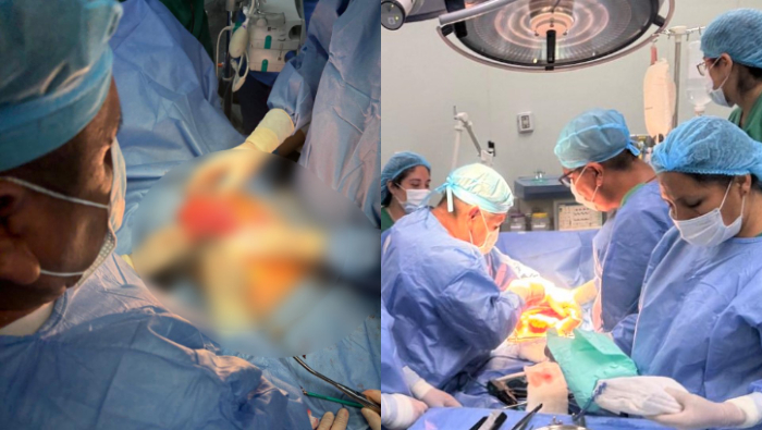 Salvan vida de adolescente luego de extirparle un tumor que comprometía el 90% de su estómago