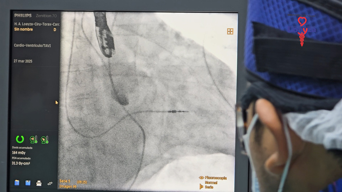 Éxito en el Reemplazo Valvular Aórtico por Cateterismo cardíaco a Paciente de 87 Años en el Hospital Loayza