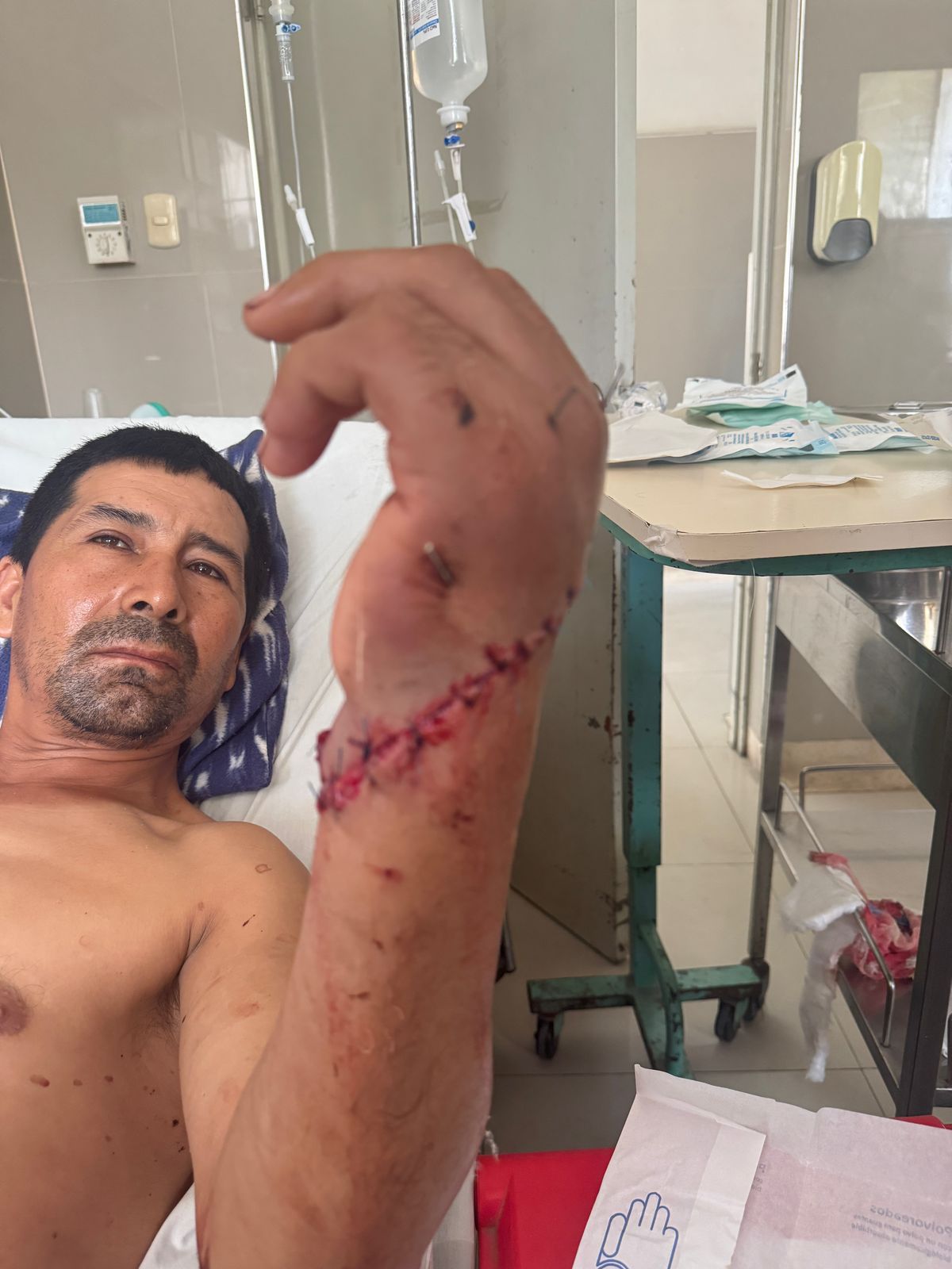Hospital Nacional Sergio E. Bernales realiza con éxito re-implante de mano a obrero
